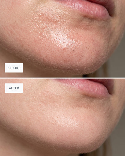 Before and after: a chin with fewer breakouts along the jawline