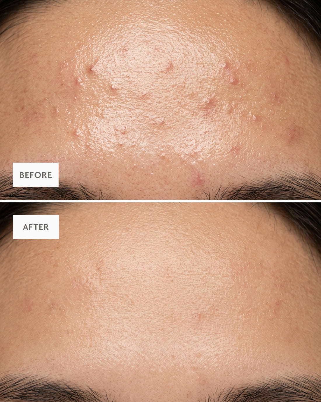 Before and after: a forehead with fewer breakouts across the T-zone