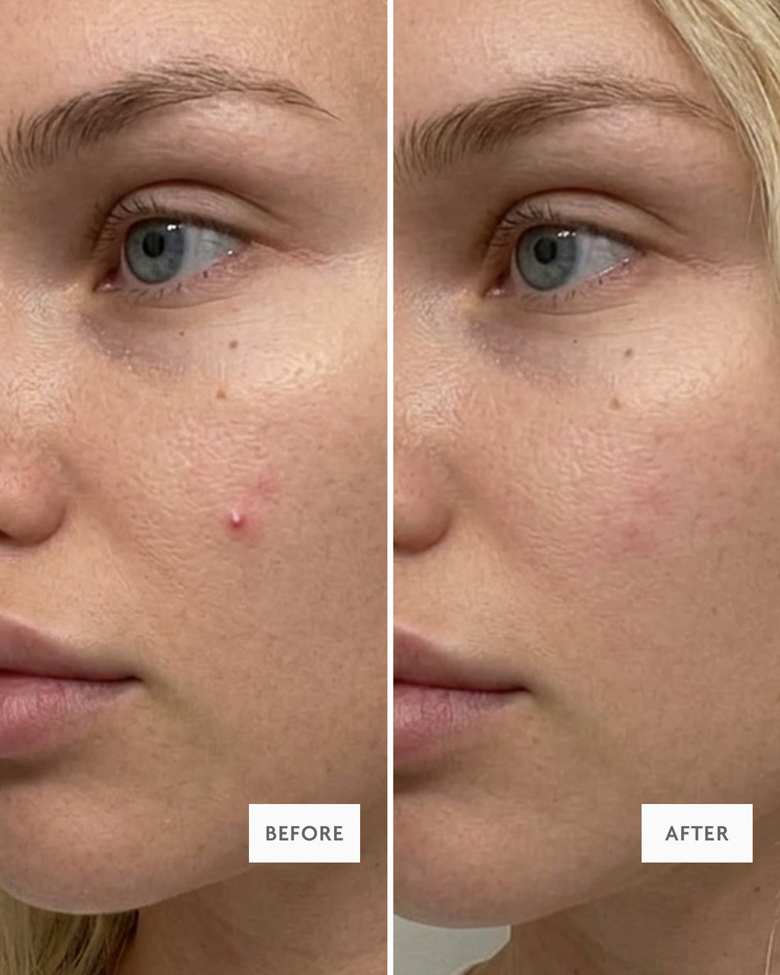 Before and after: a single pimple flattened overnight with a spot patch
