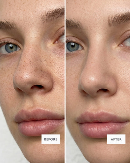 Miracle Nose Patches