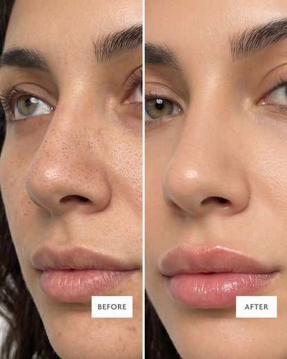 Miracle Nose Patches