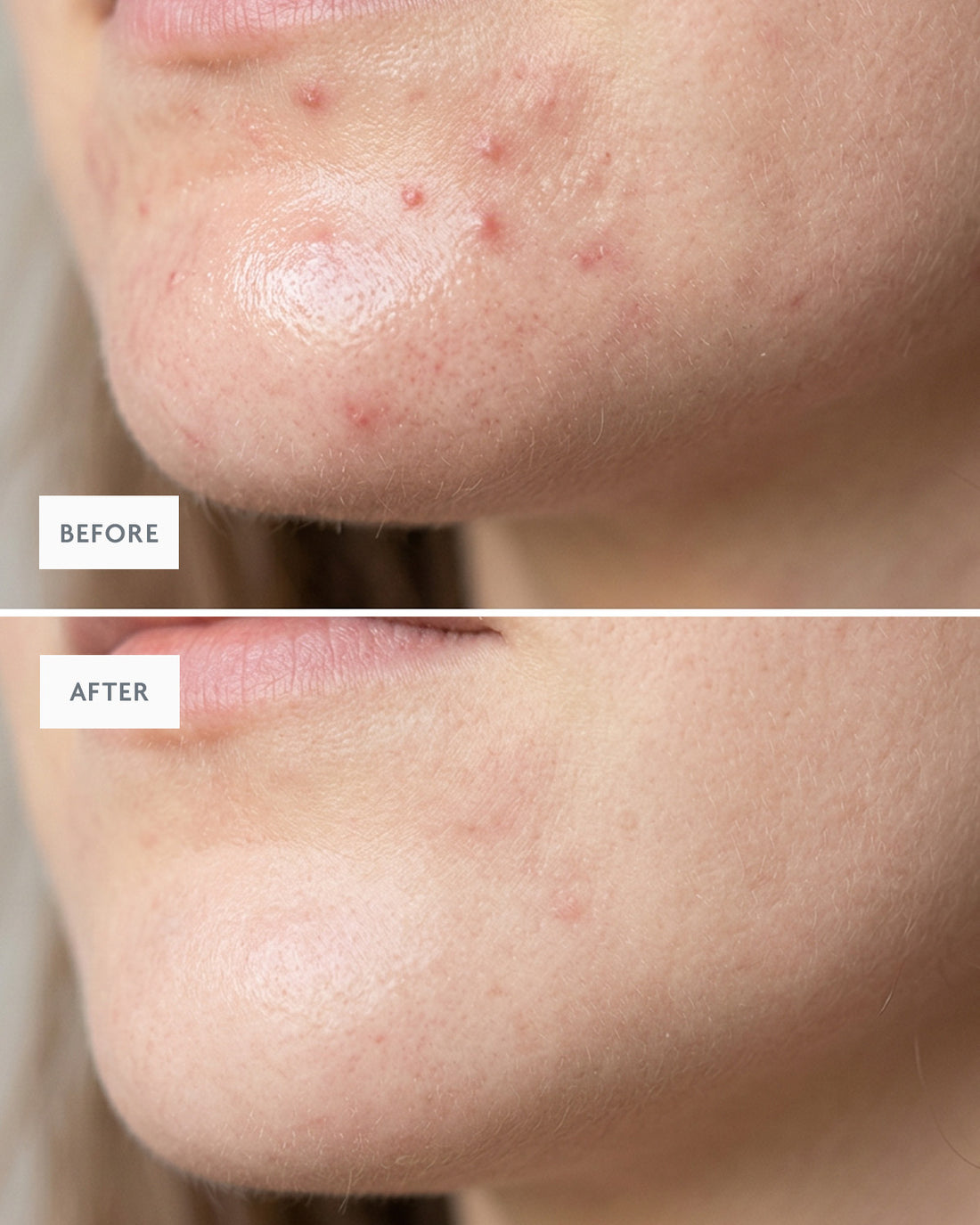 Close-up before and after of a clearer chin and jawline