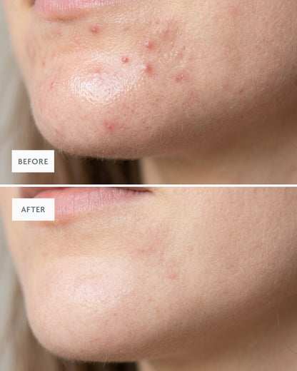 Close-up before and after of a clearer chin and jawline