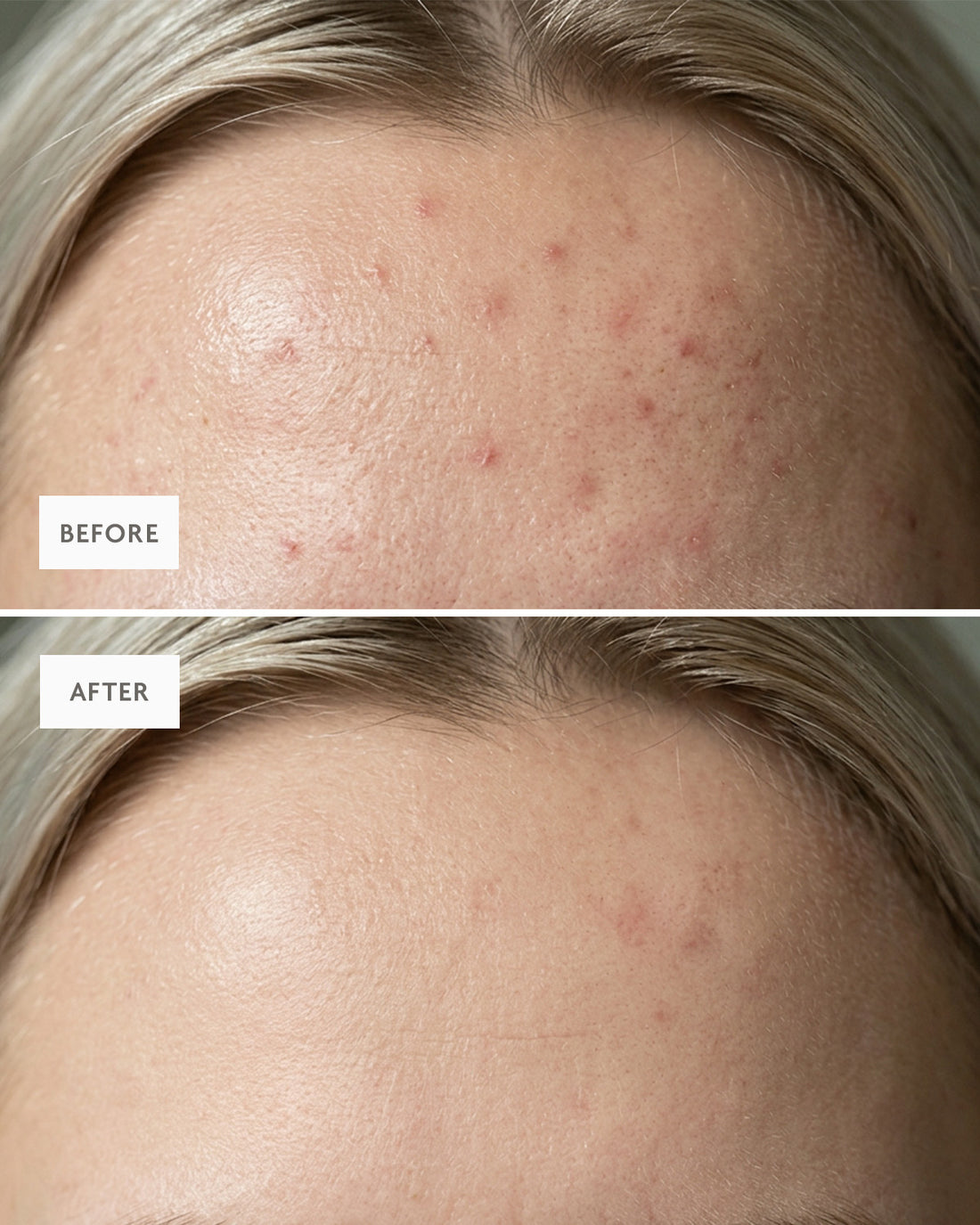 Close-up before and after of a clearer, less shiny forehead