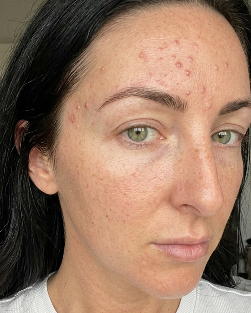 Before and after result with KYLA forehead patches