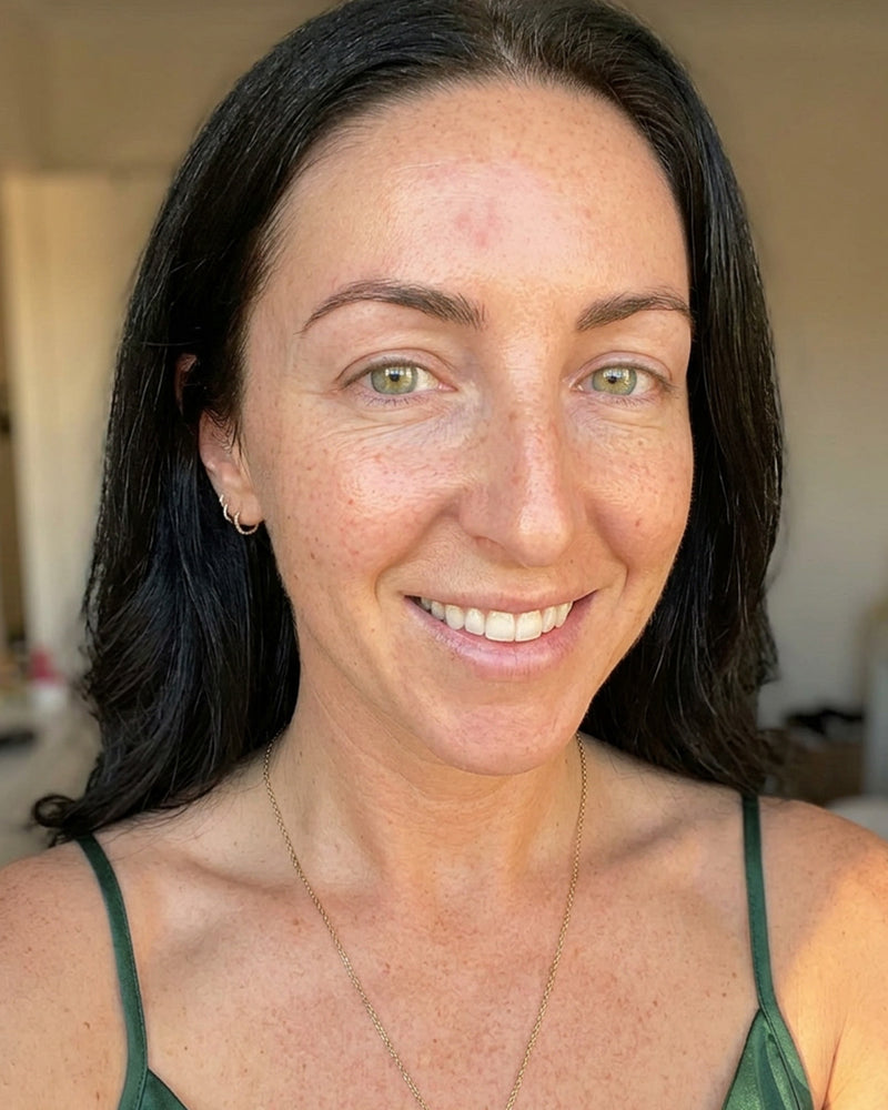 Clearer forehead after using KYLA forehead patches