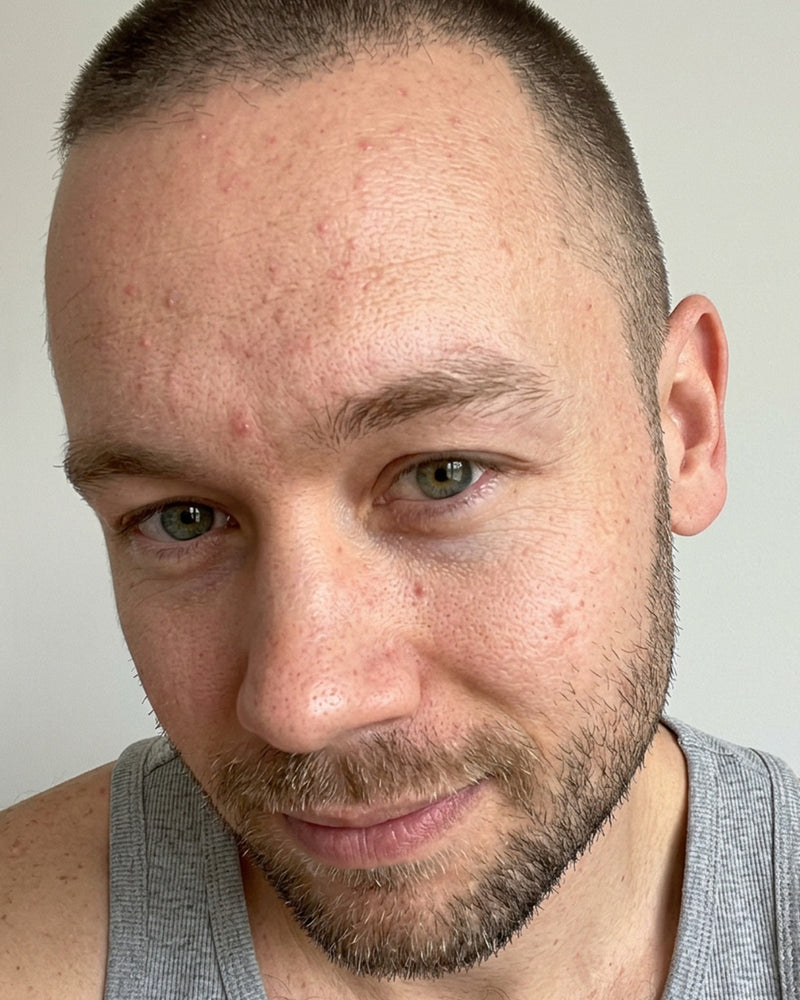 Before and after result with KYLA forehead patches