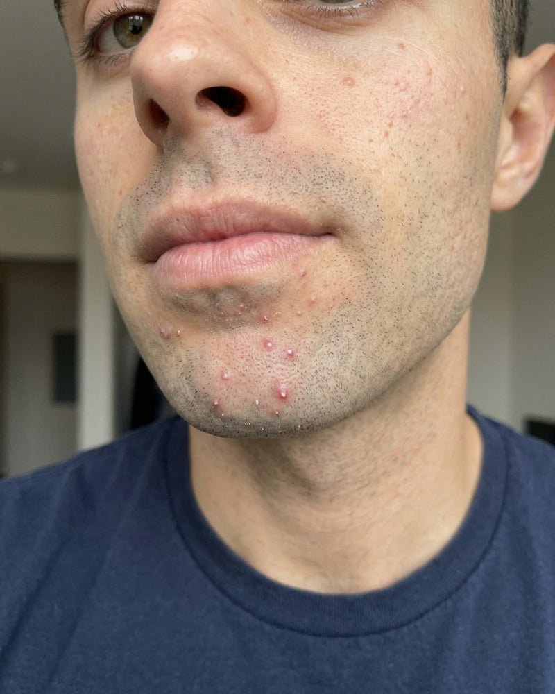 Before and after result with KYLA chin patches