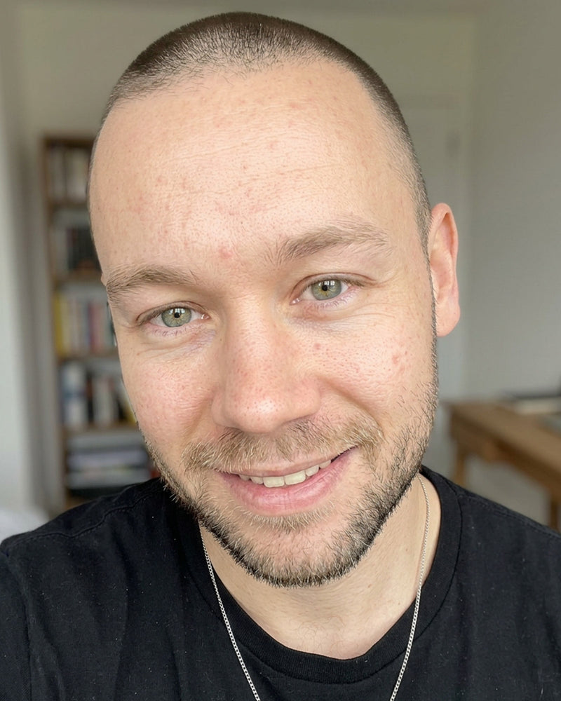 Clearer forehead after using KYLA forehead patches