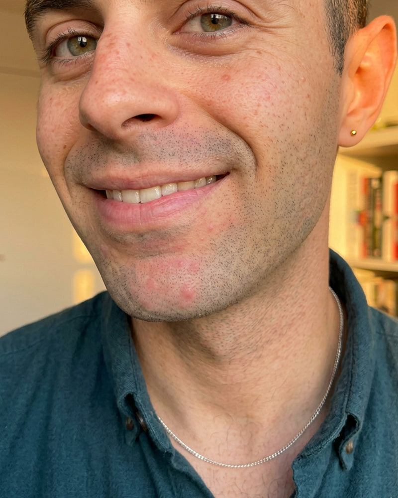 Clearer chin after using KYLA chin patches