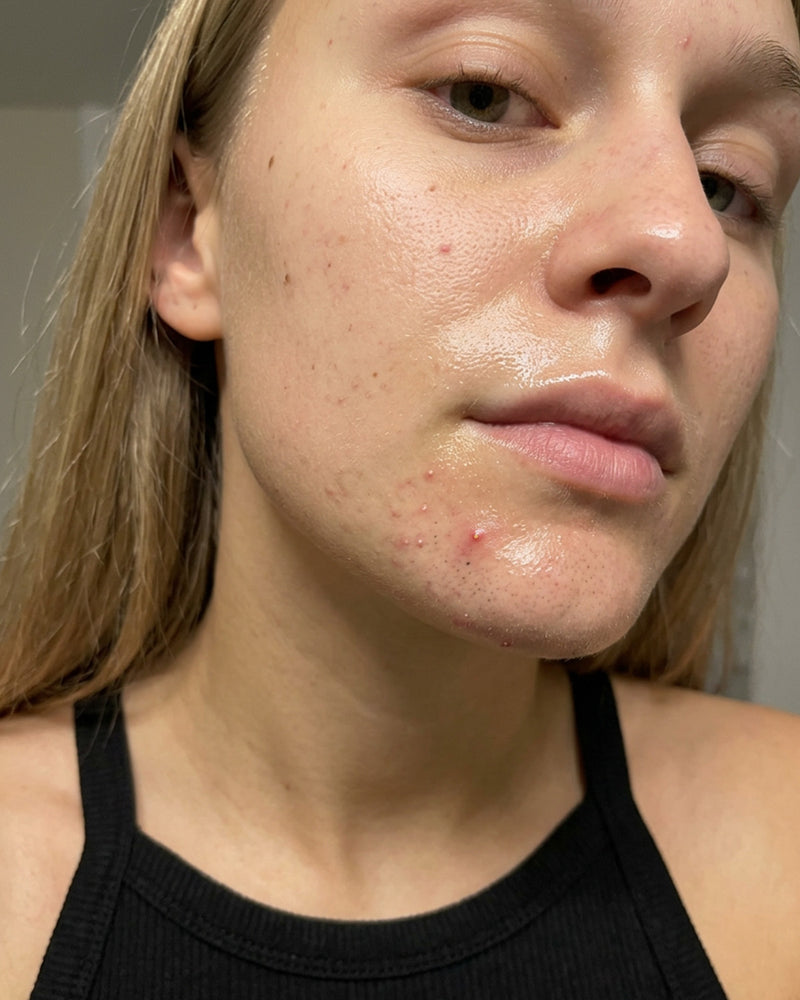Before and after result with KYLA chin patches