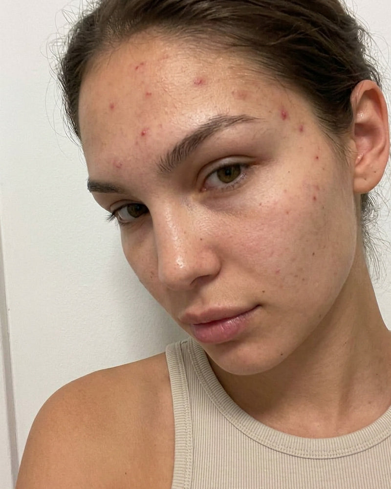 Before and after result with KYLA forehead patches