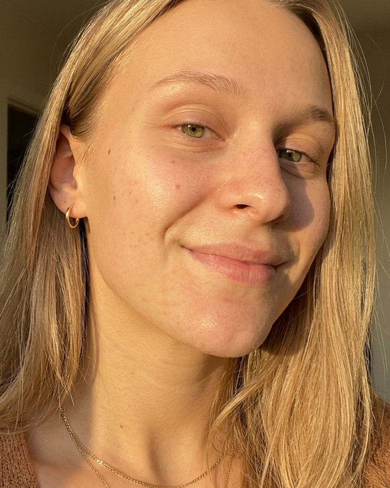 Clearer chin after using KYLA chin patches