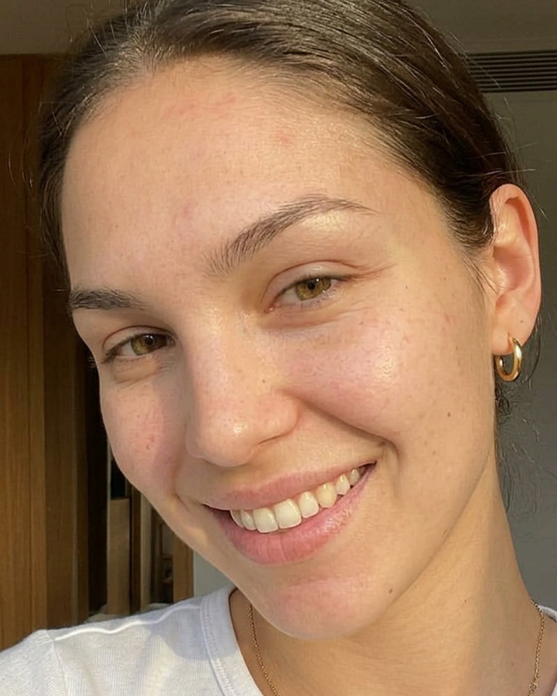 Clearer forehead after using KYLA forehead patches