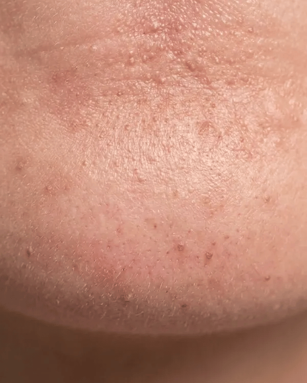 KYLA hydrocolloid chin patch in use, short animation