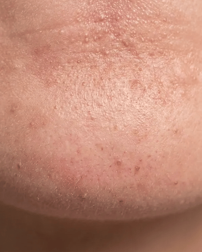 KYLA hydrocolloid chin patch in use, short animation