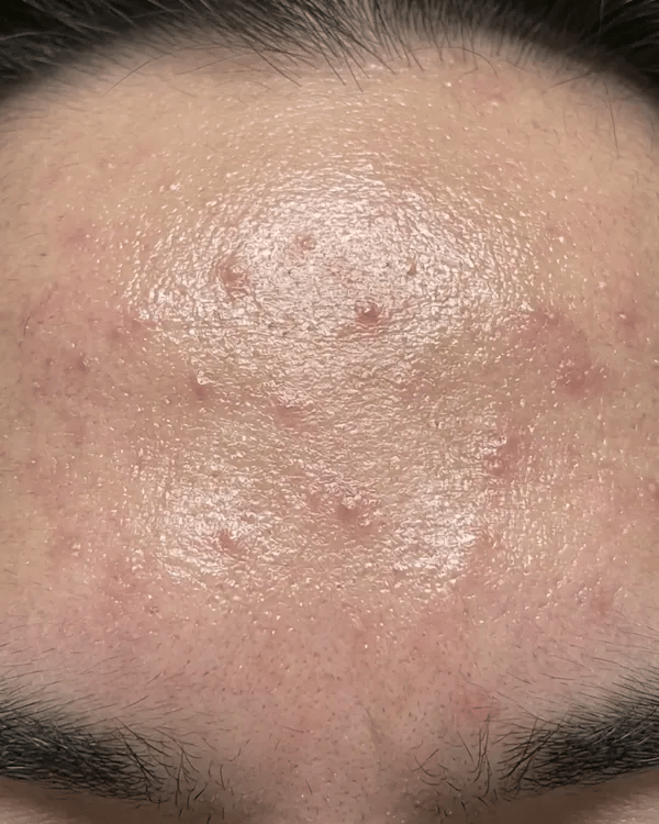 KYLA hydrocolloid forehead patch in use, short animation