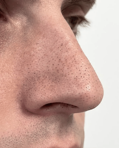 Miracle Nose Patches